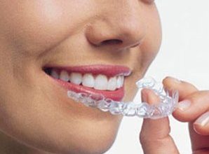 Чи варто ставити брекети?
