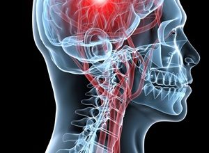 Інсульти вийшли на перше місце серед причин смертності в Україні